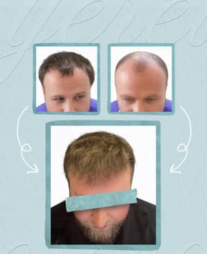 Slider image (2) United Hair Clinic